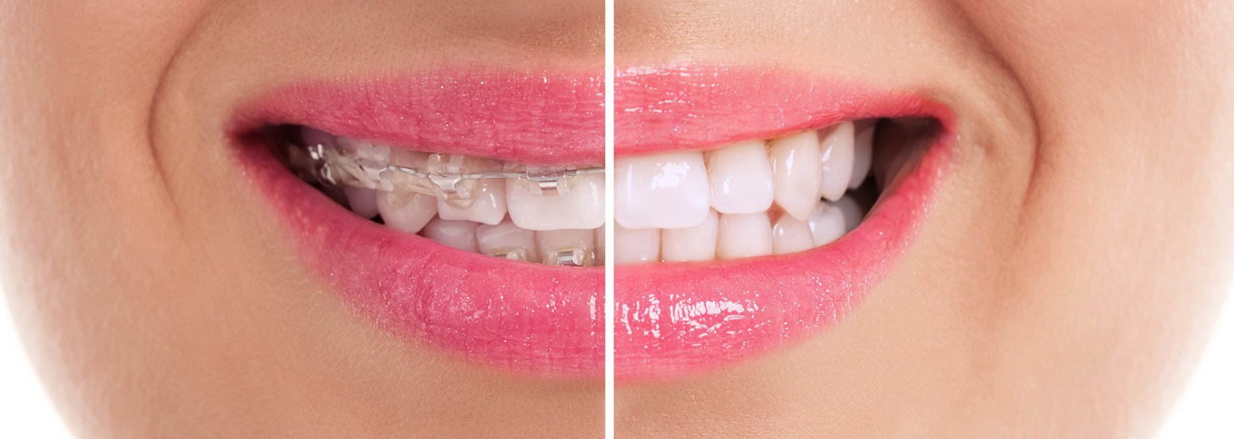 Braces remove- before after result